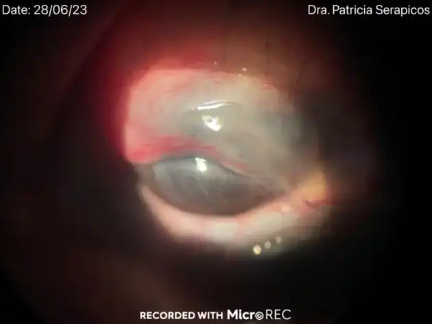 Eye ulcer